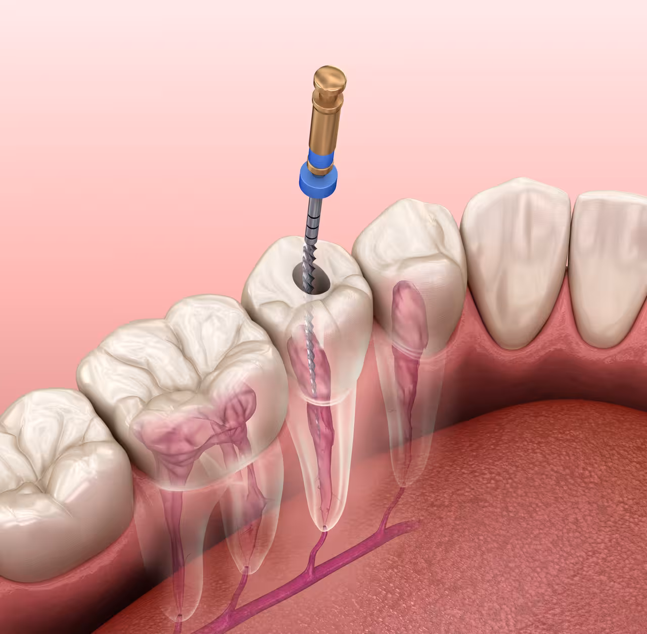 Root Canals in South Lake Tahoe